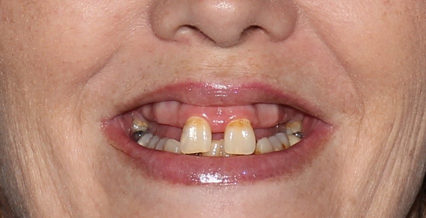 Upper Partial Dentures Pickrell NE 68422